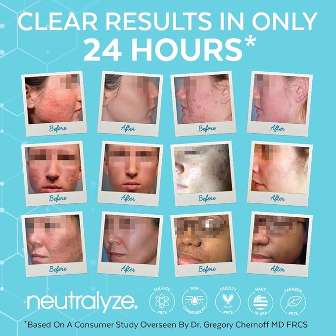 Neutralyze Exfoliating Acne Treatment Wipes - Maximum Strength, Textured Acne Pads with 2% Mandelic Acid & 2% Salicylic Acid for Face & Body - Suitable for All Skin Types, Teens & Adults (100 Wipes)
