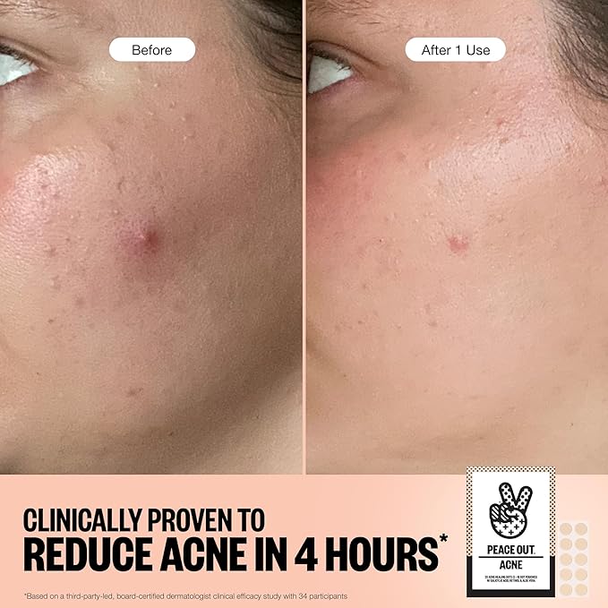 PEACE OUT Acne Healing Dots Helps Clear Blemishes Overnight, Fast Acting Hydrocolloid Pimple Patches for Breakouts with Salicylic Acid, Retinol and Aloe Vera, Award Winning Skincare Solution 40 Count